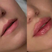 تخفیف ژل لب و بوتاکس فیلر مزو دکتر کاظمی|خدمات آرایشگری و زیبایی|مشهد, کوثر|دیوار