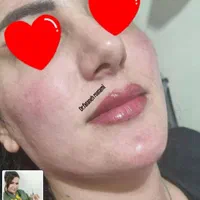 تزریق ژل و بوتاکس و آموزش حرفه ای|خدمات آرایشگری و زیبایی|اهواز, سپیدار|دیوار
