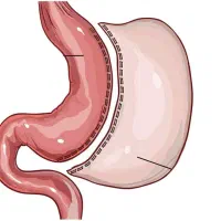 اسلیو معده و بای‌پس+متخصص جراحی چاقی +بیمه +اقساطی