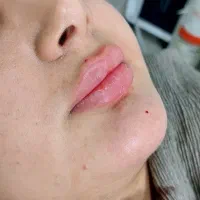 آموزش تزریقات زیبایی