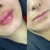 ژل و بوتاکس