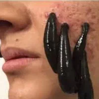 حجامت زالو طب سوزنی فصد امبدینگ رفع گرفتگی|خدمات آرایشگری و زیبایی|اصفهان, شیخ اشراق|دیوار