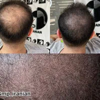 میکرو اسکالپ|خدمات آرایشگری و زیبایی|تهران, جنت‌آباد جنوبی|دیوار