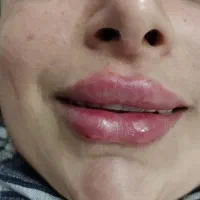 فیلر،بوتاکس،لیزر موهای زاید و تزریق انزیم