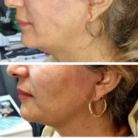 ژل بوتاکس فیلر نخ  فشیال صورت|خدمات آرایشگری و زیبایی|تبریز, |دیوار