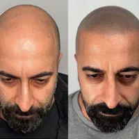آموزش و خدمات میکرواسکالپ مکمل کاشت مو|خدمات آرایشگری و زیبایی|تهران, الهیه|دیوار