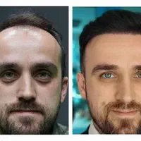 کاشت مو طبیعی،ابرو،و ریش بدون ورم و حتی کبودی|خدمات آرایشگری و زیبایی|یاسوج, |دیوار