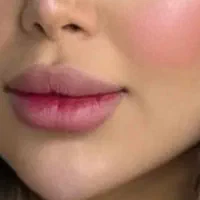 تزریق ژل بوتاکس توسط پزشک|خدمات آرایشگری و زیبایی|کرمانشاه, |دیوار