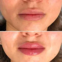 انجام خدمات زیبایی ،بوتاکس ،فیلر،مروتراپی ،مزوژل و|خدمات آرایشگری و زیبایی|تهران, نیروی هوایی (پیروزی)|دیوار