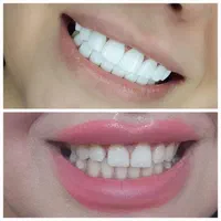 کامپوزیت دندان (( طرح لبخند ))|خدمات آرایشگری و زیبایی|یاسوج, |دیوار