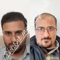 کاشت مو و ابرو و سبیل