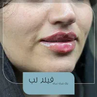 تزریق ژل از ۱۴۹۰ ،بوتاکس از ۶۵۰، پکیج فول فیس ۹/۵|خدمات آرایشگری و زیبایی|تهران, گلستان (شهرک راه آهن)|دیوار