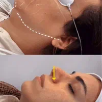 هایفوتراپی