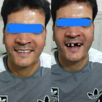 دندانسازی ساخت انواع دندان مصنوعی|خدمات آرایشگری و زیبایی|مشهد, رسالت|دیوار