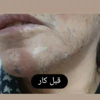 الکترولیز موی سفید وسیاه صورت بانوان فقط|خدمات آرایشگری و زیبایی|بروجرد, |دیوار