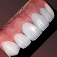 دندانپزشکی کامپوزیت ایمپلنت عصب کشی پر کردن|خدمات آرایشگری و زیبایی|قدس, |دیوار