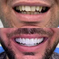 دندانپزشکی بدون پیش پرداخت عصب کشی . کامپوزیت و...|خدمات آرایشگری و زیبایی|قم, عمار یاسر|دیوار