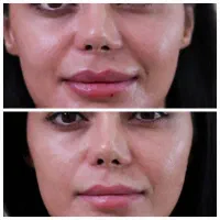 تزریق انواع بوتاکس ،ژل،مزوتراپی ،نخ.انزیم|خدمات آرایشگری و زیبایی|مشهد, سرافرازان|دیوار