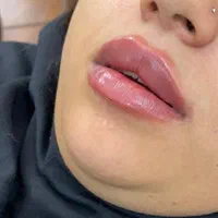 ژل لب متود روسی توسط پزشک حرفه ای|خدمات آرایشگری و زیبایی|حمیدیا, |دیوار