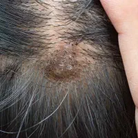 پاکسازی رشک وشپش
