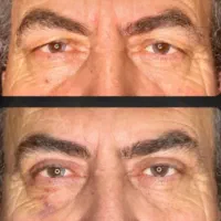 بلفاروپلاستی رفع افتادگی پلک لیزری/سانترال/بوکالفت|خدمات آرایشگری و زیبایی|تهران, هفت حوض|دیوار