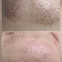 حذف موهای زائد، دائمی (الکترولیز مو) / حذف کک و مک