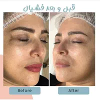 فشیال پوست وپلاژن تراپی درکلینیک با دستگاه|خدمات آرایشگری و زیبایی|کرج, کوی زنبق|دیوار