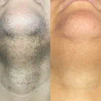 پوستی صاف و زیبا با لیزر تیانیوم و نتیجه ماندگار|خدمات آرایشگری و زیبایی|مشهد, آزادشهر|دیوار