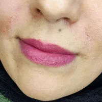 تزریق ژل وبوتاکس|خدمات آرایشگری و زیبایی|قم, بکایی|دیوار