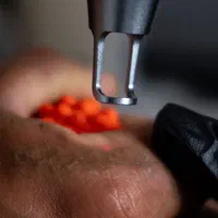 مرکز لیزر مو های زائد کندلا پاک کردن تتو کربن