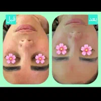ژل وبوتاکس|خدمات آرایشگری و زیبایی|اهواز, پردیس دو|دیوار