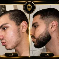 رویش فوری ریش در ۱۵ روز