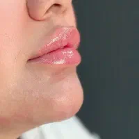 تزریق فیلر نورامیس صورت لب|خدمات آرایشگری و زیبایی|تهران, تهرانسر مرکزی|دیوار