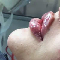 تزریق ژل و بوتاکس