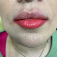 تزریق فیلر،بوتاکس،مزوتراپی