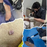 درمان قطعی زگیل تناسلی توسط پزشک