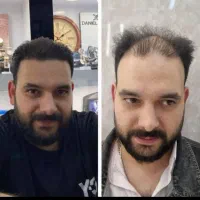 کاشت مو/کاشت ریش/کاشت ابرو اقساط*ی در اصفهان|خدمات آرایشگری و زیبایی|فولادشهر, فولادشهر|دیوار