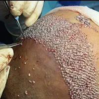 کاشت موی طبیعی -بازگشت اعتماد بنفس شما در یک جلسه