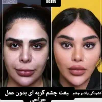 لیفت فول فیس صورت لیفت چشم گربه ای بدون عمل جراحی|خدمات آرایشگری و زیبایی|ری, دیلمان|دیوار