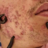 مرکز حجامت زالو درمانی بادکش و خدمات پزشکی درمنزل|خدمات آرایشگری و زیبایی|قزوین, |دیوار