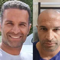 ترمیم و کاشت مو