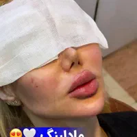 ژل بوتاکس فیلر چربی مزو جوانساز بلفارو درمطب پزشک|خدمات آرایشگری و زیبایی|کرج, گوهردشت|دیوار