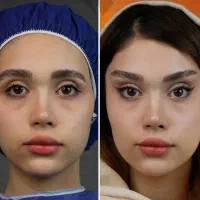 آف۵۰٪پکیج ابرو FOX EYE پزشک پلک غبغب ژل بینی شقیقه|خدمات زیبایی و سلامت|مشهد, هنرستان|دیوار