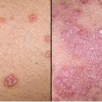 درمان پسوریازیس به صورت ریشه ای|آرایشی، بهداشتی، درمانی|جیرفت, |دیوار