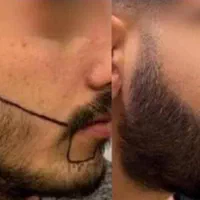 کاشت مو طبیعی،ابرو،و ریش بدون ورم و حتی کبودی|خدمات آرایشگری و زیبایی|یاسوج, |دیوار