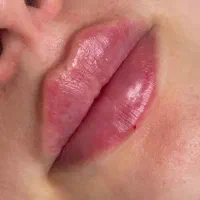 خدمات تزریق فیلر/ بوتاکس/مزوتراپی