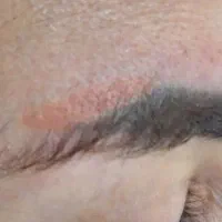 لیزر بوتاکس فیلر پی ار پی هایفو خال  الکترولیز