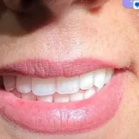دندان سرامیکی طرح لمینت تحویل چندساعته