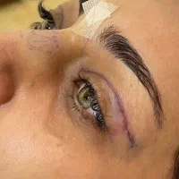 تخفیف بلفاروپلاستی