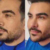 تخفیف ویژه ژل بوتاکس فیلرمردان با پی ار پی رایگان